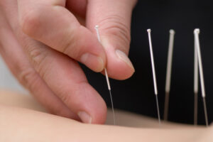 Acupuncture | Gold Living Acupuncture 1 Gold Living Acupuncture Acupuncture | Gold Living Acupuncture